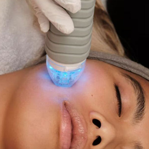 Microneedling